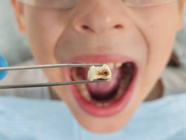 Best Emergency Broken Tooth Repair in Spring Arbor, MI